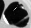 Polype sessile